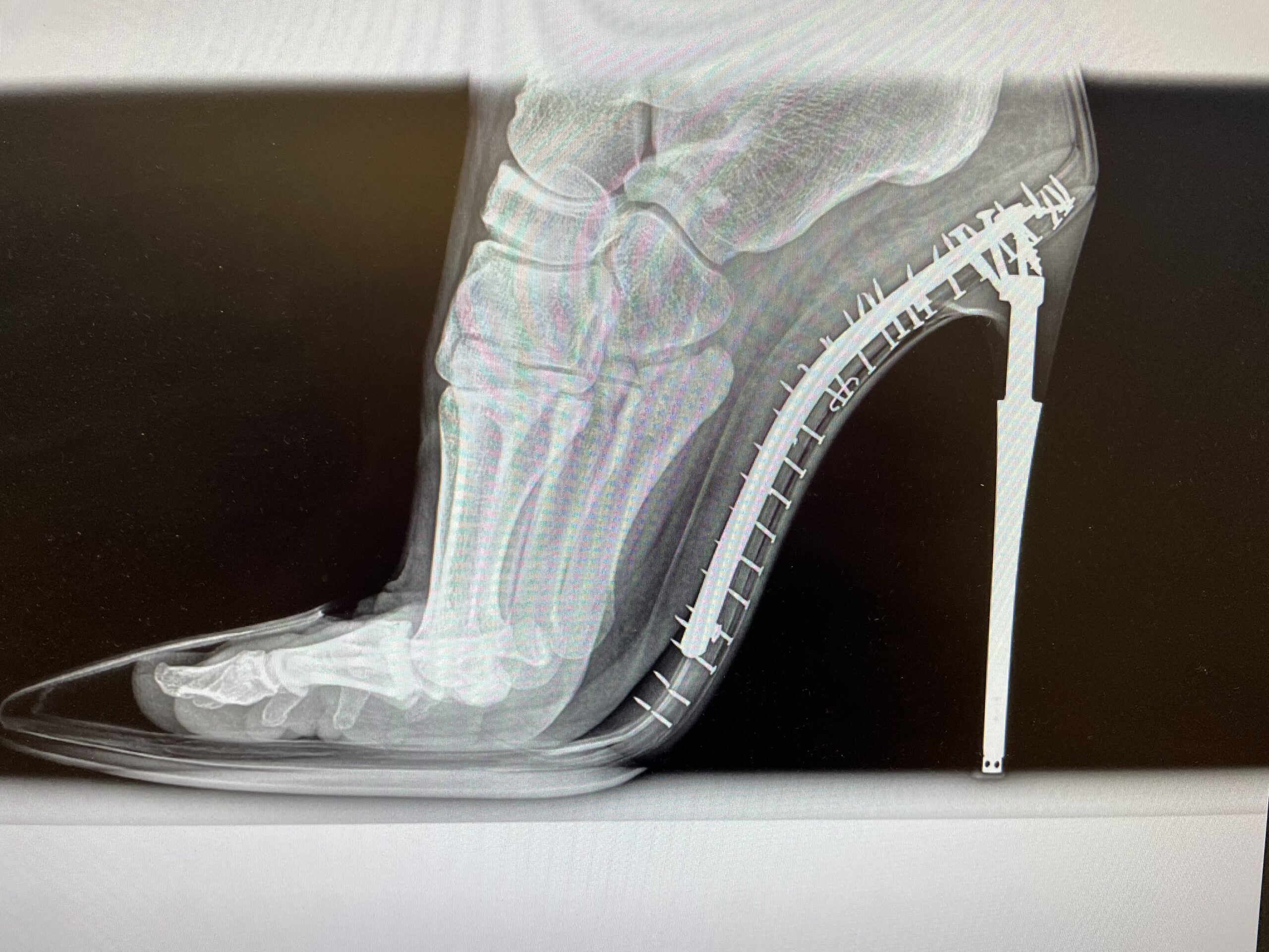 Do You Have Pain In The Back Of Your Heel? It Could Be Achilles Insertional Tendinopathy.